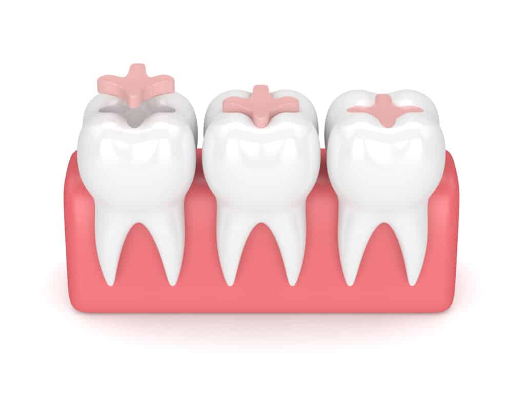 dental inlays ma