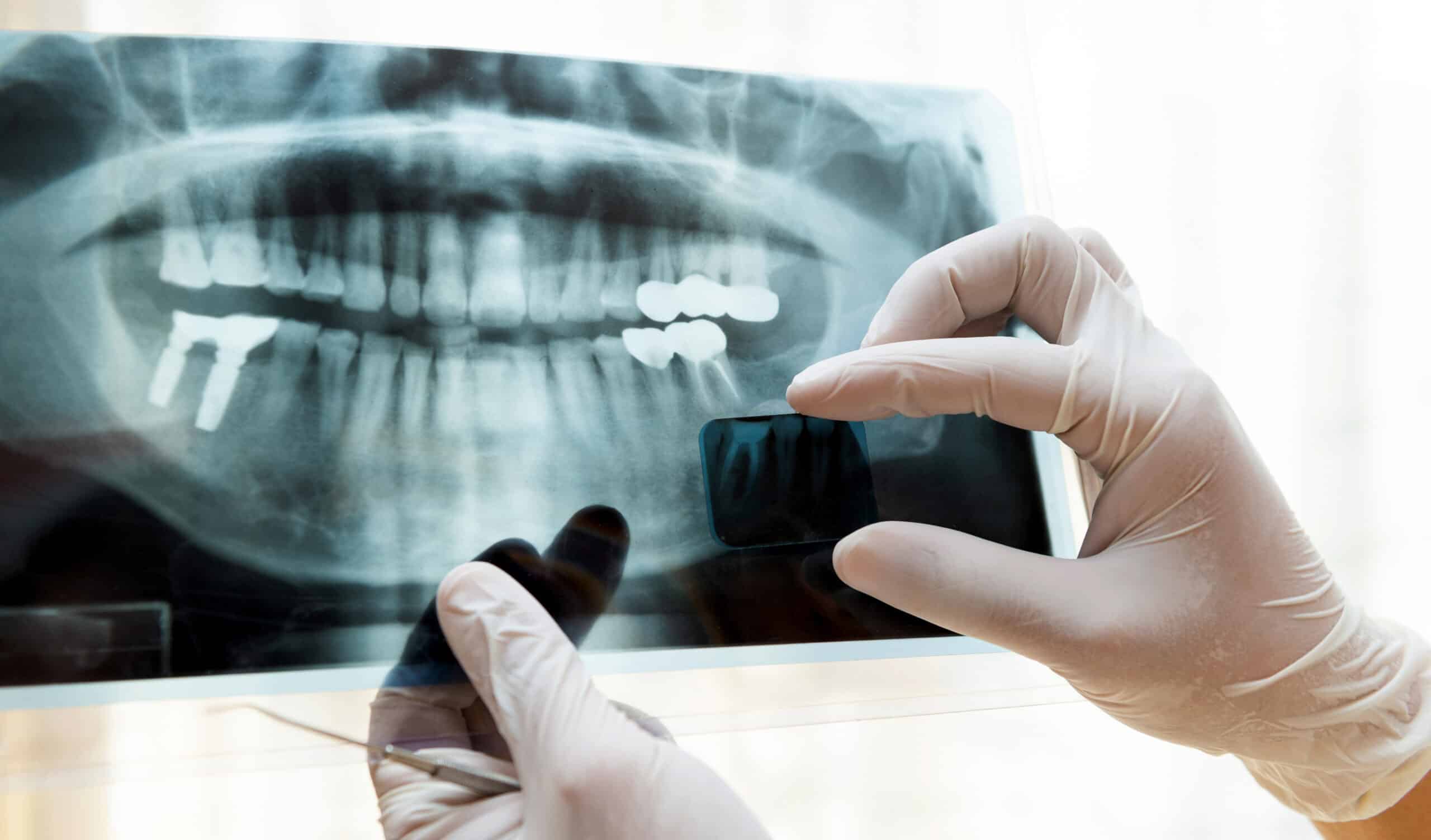 The History of Dental XRays in Massachusetts Smile Boutique Dental