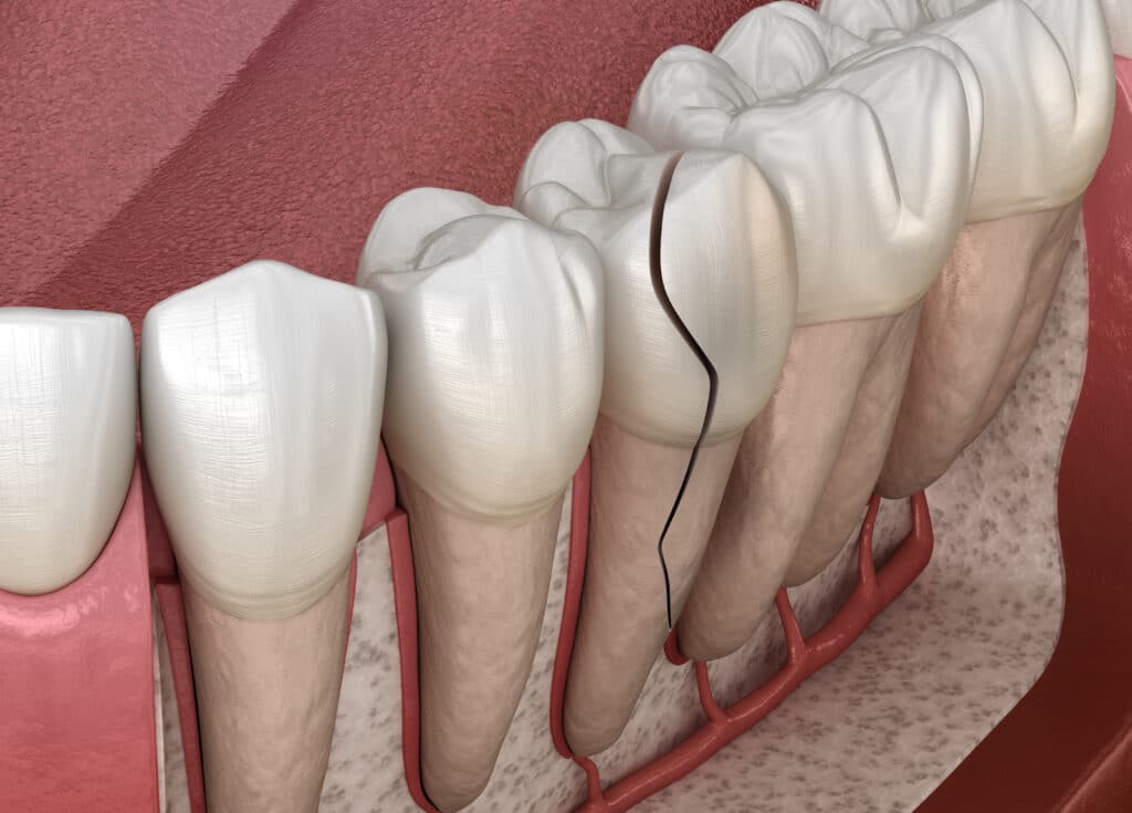 cracked tooth MA